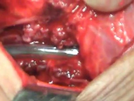 Perforation of a Esophageal Carcinoma after the procedure with hydrostatic balloon dilation (8 of 12)