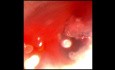 Subglottic stenosis