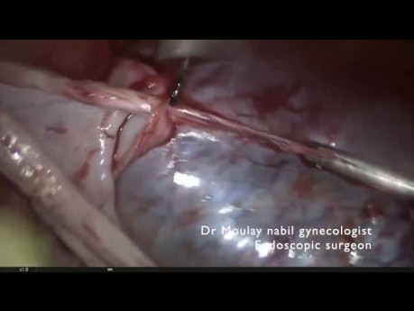 Managementof a Big Ovarian Cyst in the Context of Infertility
