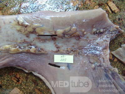 Early Gastric Cancer (15 of 21)