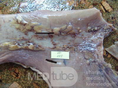 Early Gastric Cancer (15 of 21)