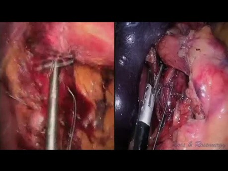 LESS Nissen Fundoplication; Utilizing Revolutionary Technology for Suturing