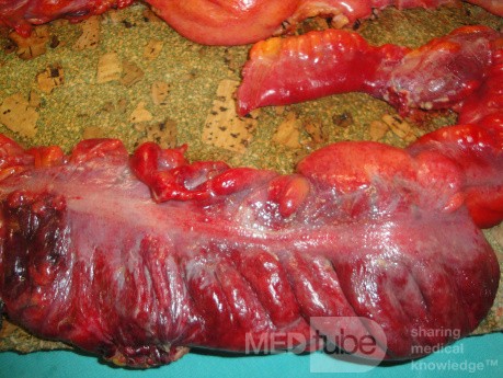 Multiple Rectal Ulcers (81 of 110)
