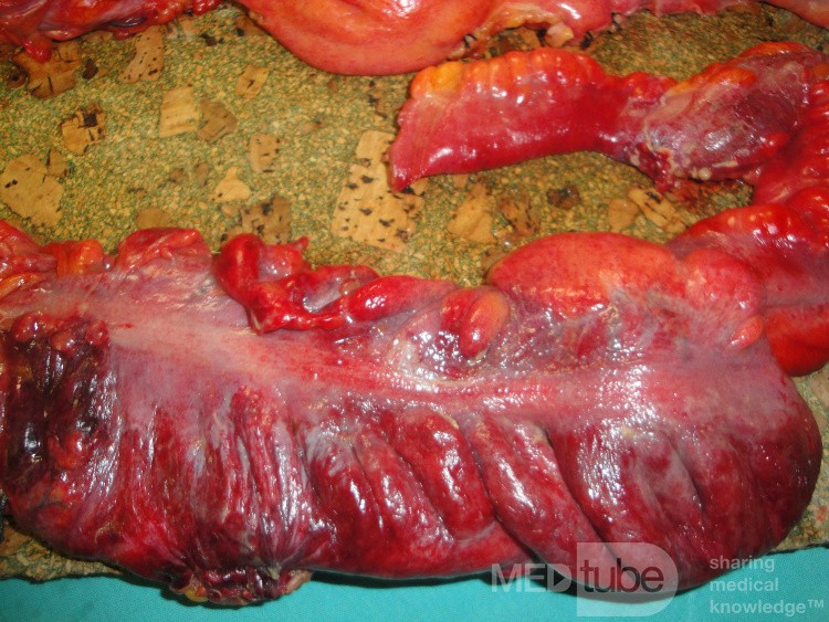 Multiple Rectal Ulcers (81 of 110)