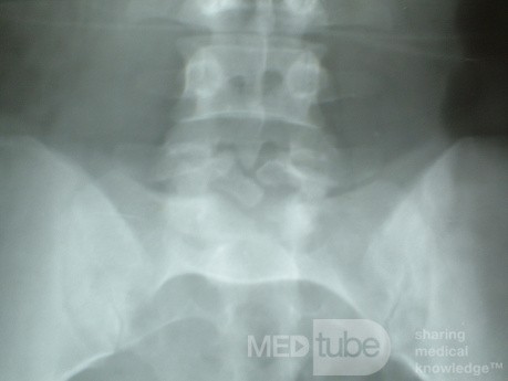 Spina Bifida Oculta