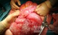 Pneumatosi Cystica Intestinalis: Occlusion and Perforation in the Same Patient