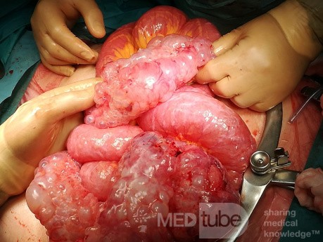 Pneumatosi Cystica Intestinalis: Occlusion and Perforation in the Same Patient
