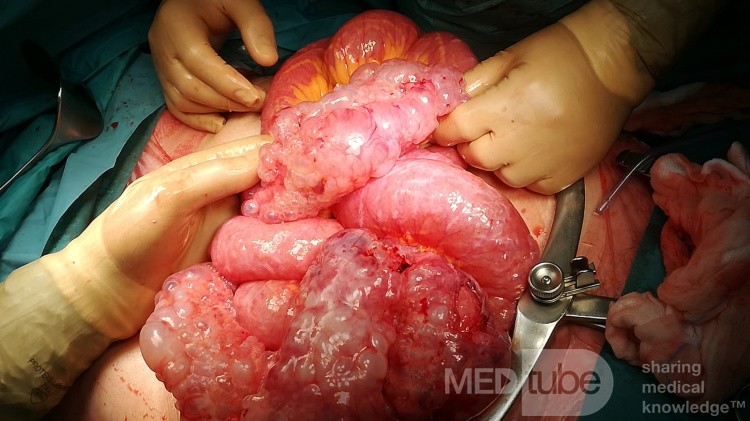 Pneumatosi Cystica Intestinalis: Occlusion and Perforation in the Same Patient