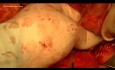 Surgery for Giant Abdominal Sarcoma with Right Hemicolectomy