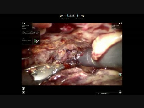 Total Urethrovesical Anastomotic Disruption: a Video Case Report