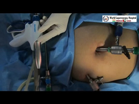 Laparoscopic Ablation and Fulguration of Endometriosis of Cul-De-Sac