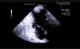 Chordae Tendineae (Longer Version)