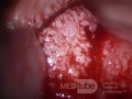 Cervical adenocarcinoma (carcinoma glandulare colli uteri)
