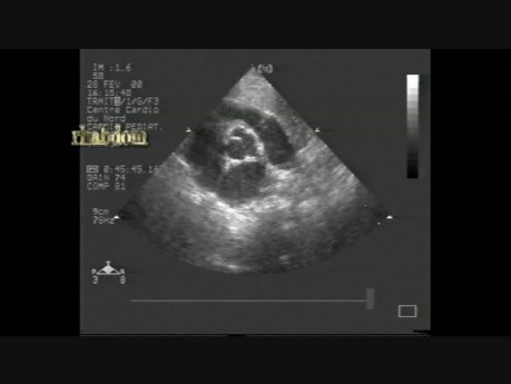 Multiple Cardiac Rhabdomyoma - 1