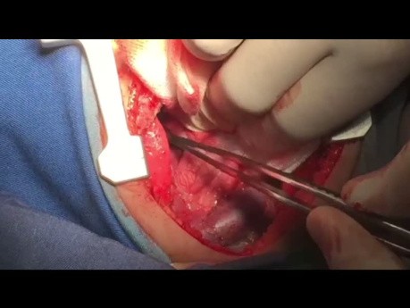 A to Z Steps of Repairing Total Annamalous Pulmonary Venous Return
