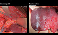 Posterior Right Sectionectomy with Resection of the Right Hepatic Vein, for Colon Cancer Metastasis