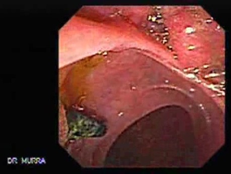 Adenocarcinoma of the Gallbladder (1 of 3)