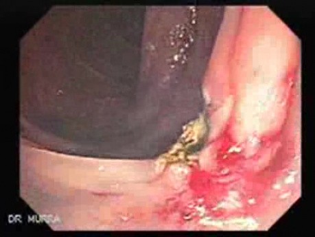 Colon Angiodysplasia (11 of 24)