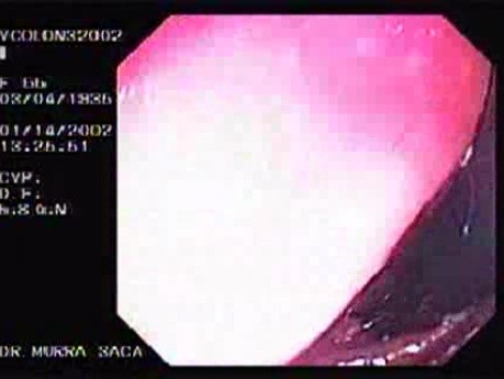 Rectal Endoscopy - Adenocarcinoma (3 of 3)
