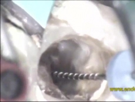 Endodontic cases