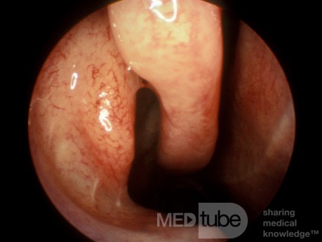 Enlarged and Medially Rotated Uncinate Process
