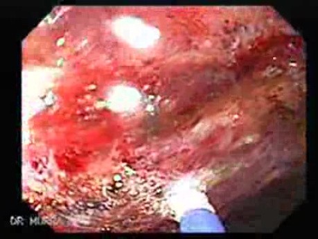 Post-Radiation Colitis (10 of 13)