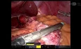 Robotic Roux-en-Y Gastric Bypass (RYGB) with Hiatal Hernia Repair