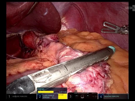 Robotic Roux-en-Y Gastric Bypass (RYGB) with Hiatal Hernia Repair
