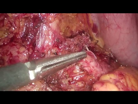Laparoscopic Enucleation of Pancreatic Insulinoma - Full Length Video