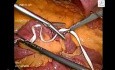 Laparoscopic Choledochal cyst 