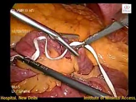 Laparoscopic Choledochal cyst 