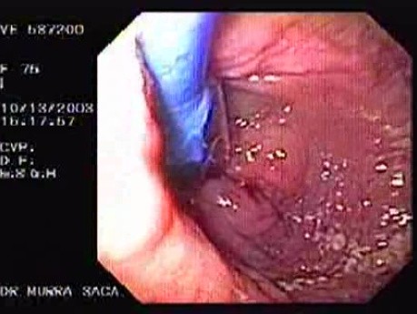 Achalasia - Induction of Certain Peristalsis