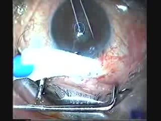 Canoacrylate In Managing Flat AC After Trabeculectomy
