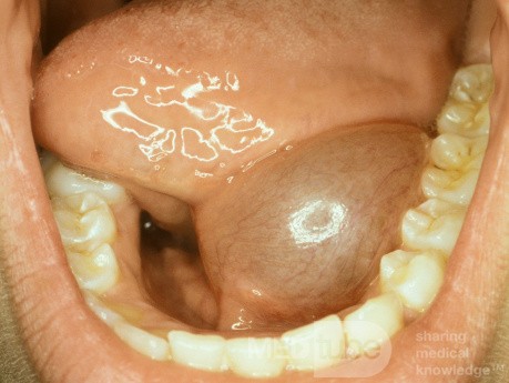 Ranula floor of the Mouth