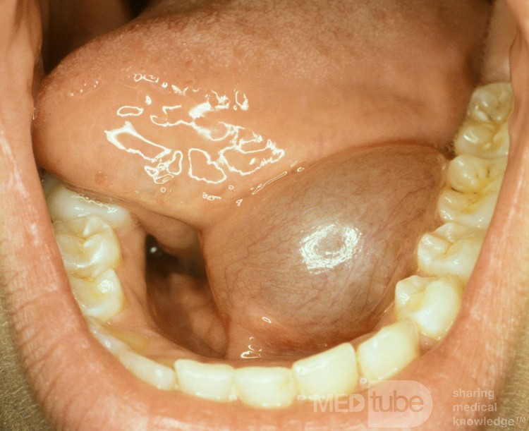 Ranula floor of the Mouth