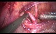 Anterior Dissection and Ligation of Uterine Artery at Its Origin in a Large Uterus