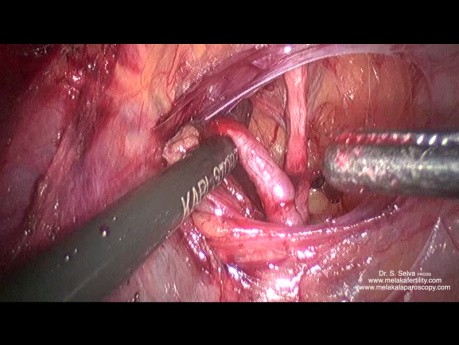 Anterior Dissection and Ligation of Uterine Artery at Its Origin in a Large Uterus
