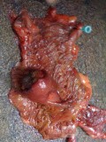 Ascending Colon Intussusception due to a Adenocarcinoma (5 of 6)