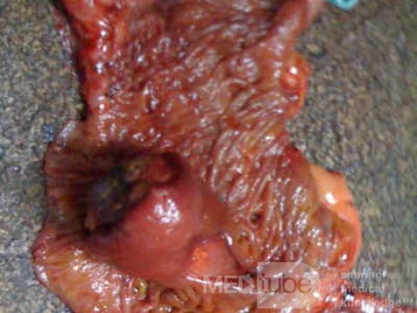 Ascending Colon Intussusception due to a Adenocarcinoma (5 of 6)