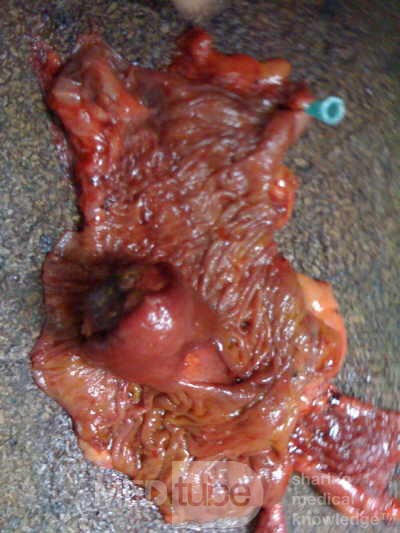 Ascending Colon Intussusception due to a Adenocarcinoma (5 of 6)