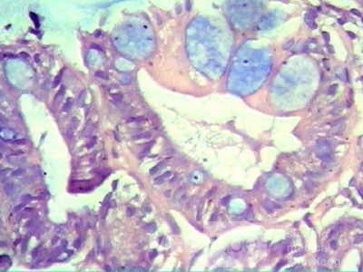 Barrett's Esophagus of long segment (24 of 24)