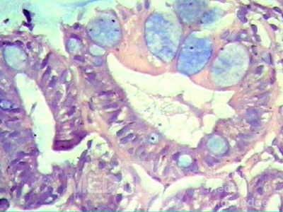 Barrett's Esophagus of long segment (24 of 24)
