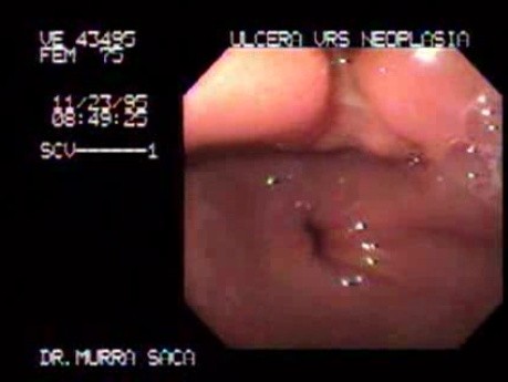 Ulcerative Gastric Carcinoma 