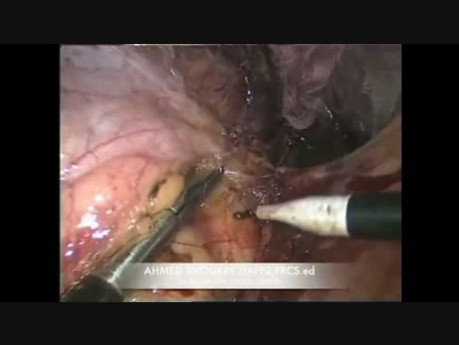 Difficult Right Laparpscopic Adrenalectomy