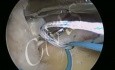 Rotator Cuff Repair