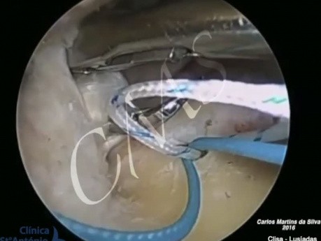 Rotator Cuff Repair