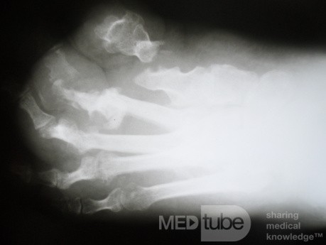 Osteomylitis 