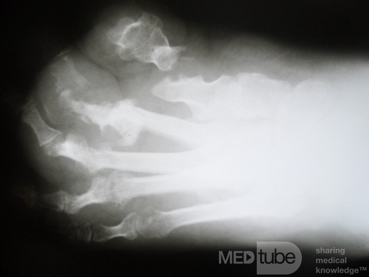 Osteomylitis 