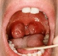 Enlarged Obstructive Tonsils
