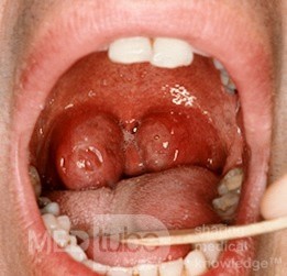 Enlarged Obstructive Tonsils
